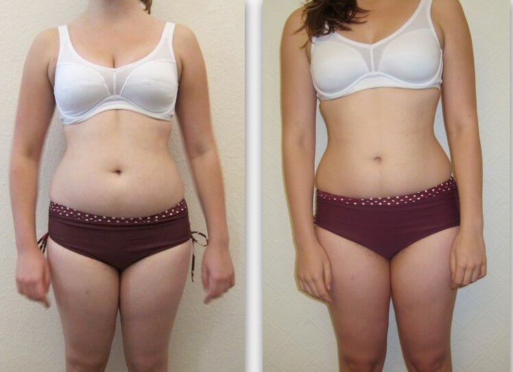 Pilates Before & After